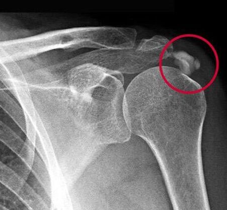 La radiografía mostró depósitos de sales de calcio en la articulación. 