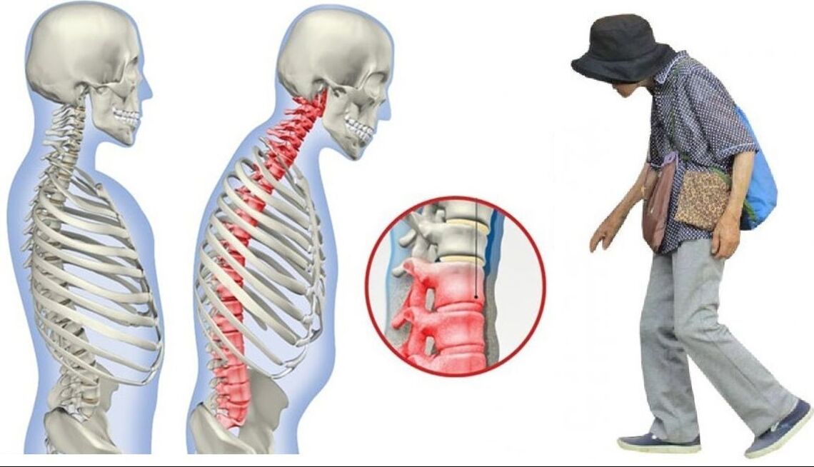 Dolor de espalda debido a espondilitis anquilosante.