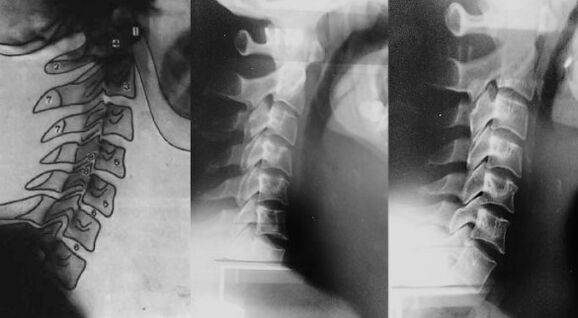 Cuello con el movimiento de la primera vértebra cervical