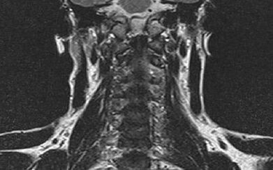 La columna cervical