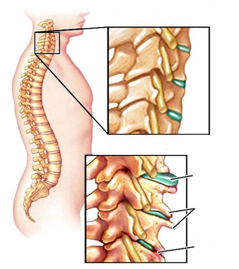 Cómo aparece la osteocondosis