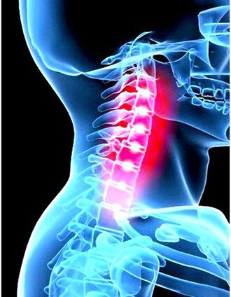 Imagen clínica de la osteocondosis