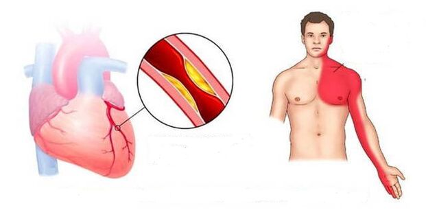 Síndrome cardial